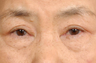 Blepharoplasty and ptosis repair