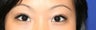 Asian Double Eyelid Surgery