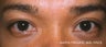 Male Asian Eyelid Surgery