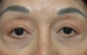 Ptosis repair