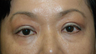 Asian blepharoplasty with internal ptosis repair