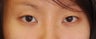 Double Eyelid Surgery - Full Incision
