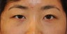 Unilateral (one-sided) Double Eyelid Surgery