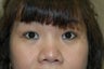 Asian eyelid surgery -- Double lid crease procedure