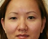 Double Eyelid procedure