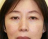 Eyelid rejuvenation