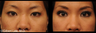 Asian Double Eyelid Surgery