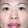Asian Eyelid Surgery