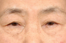Blepharoplasty and ptosis repair