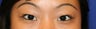 Asian Double Eyelid Surgery
