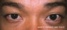 Male Asian Eyelid Surgery