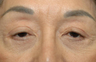 Ptosis repair