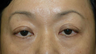 Asian blepharoplasty with internal ptosis repair