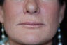 Belotero for vertical lines around the lips