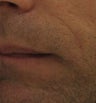 Belotero for fine etched-in lines in nasolabial folds