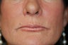 Belotero for vertical lines around the lips