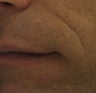 Belotero for fine etched-in lines in nasolabial folds