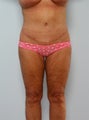 Body Lift