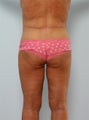 Body Lift