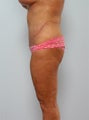 Body Lift
