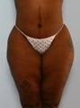 Body Lift