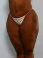 Body Lift