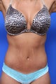 Body Lift