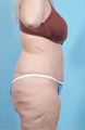 Body Lift
