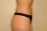 Body Lift