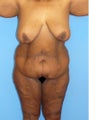High-Definition™ Total Body Lift