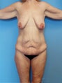 High-Definition™ Total Body Lift