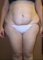 body lift