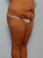 Body Lift