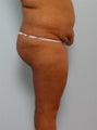 Body Lift