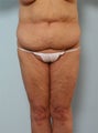 Body Lift