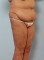 Body Lift
