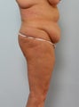 Body Lift