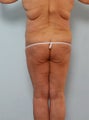 Body Lift
