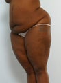 Body Lift
