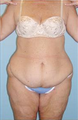 Body Lift