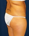 Body Lift