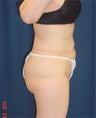 Body Lift