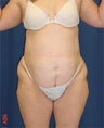 Body Lift