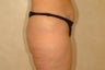 Body Lift