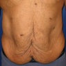 Body Lift
