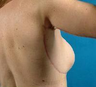 Arm Lift and Upper Body Lift