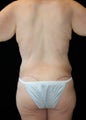 Body Lift