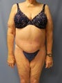 Circumferential Body Lift