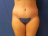 Body Lift