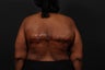 Bra Line Back Lift